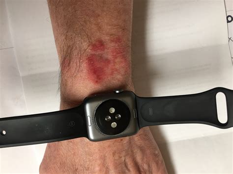 apple watch hautirritationen